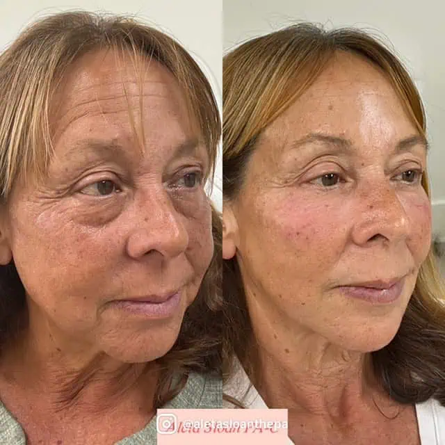 Skin-Rejuvenation in Wilmington, NC