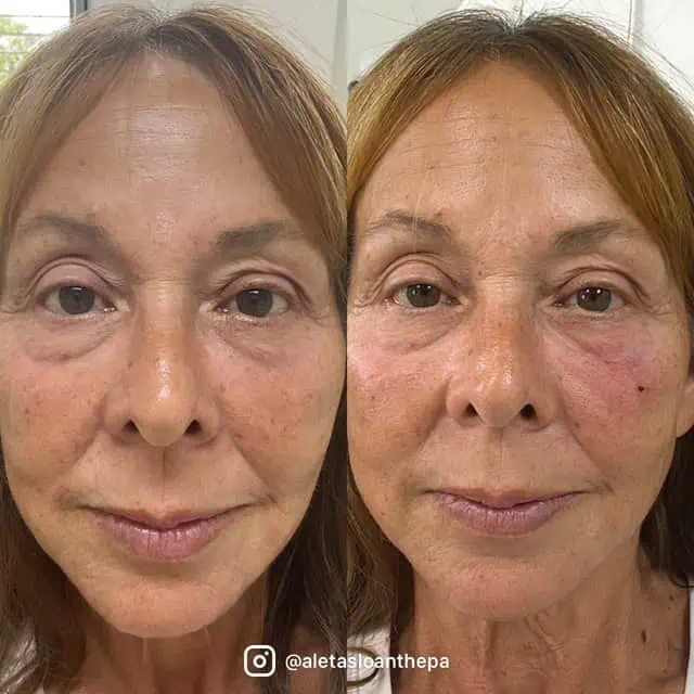 Skin Rejuvenation in Wilmington, NC
