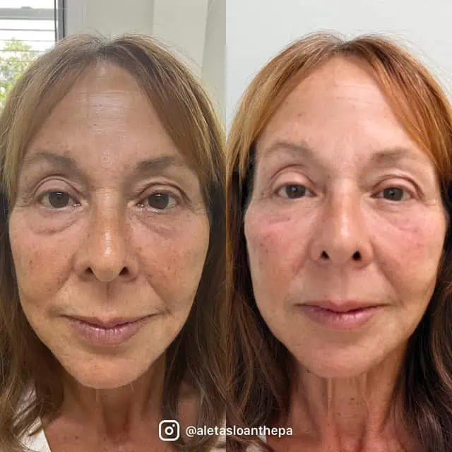 Skin-Rejuvenation in Wilmington, NC