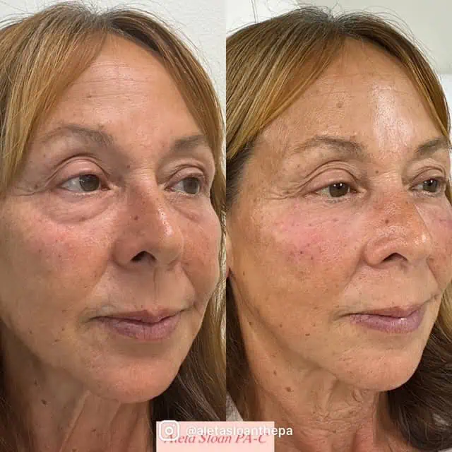 Skin-Rejuvenation in Wilmington, NC