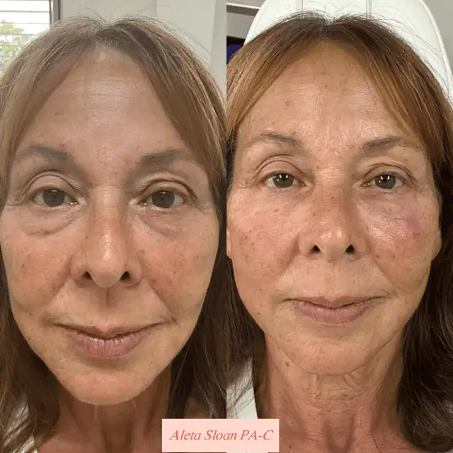Skin-Rejuvenation in Wilmington, NC