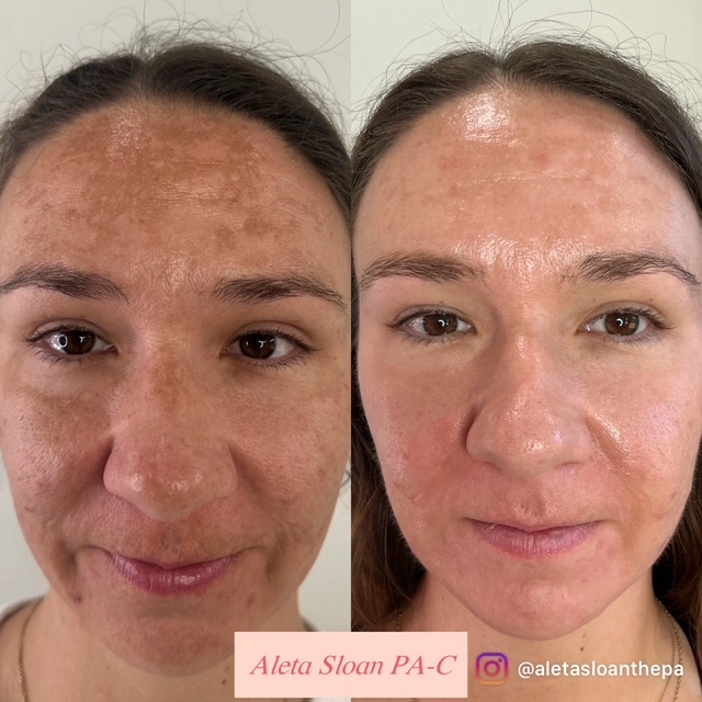 Eyebrows Treatment in Wilmington, NC