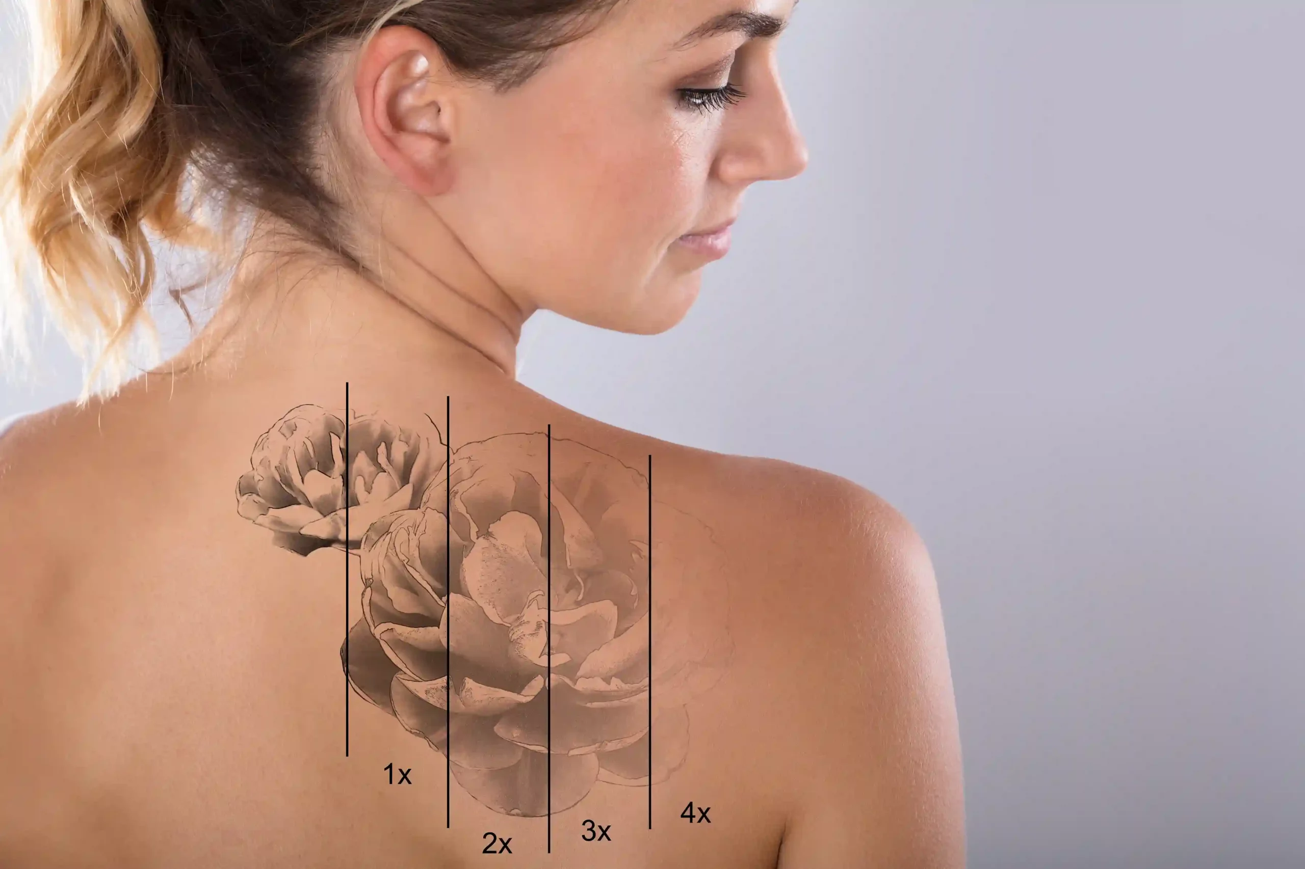 PicoWay® Tattoo Removal in Wilmington, NC